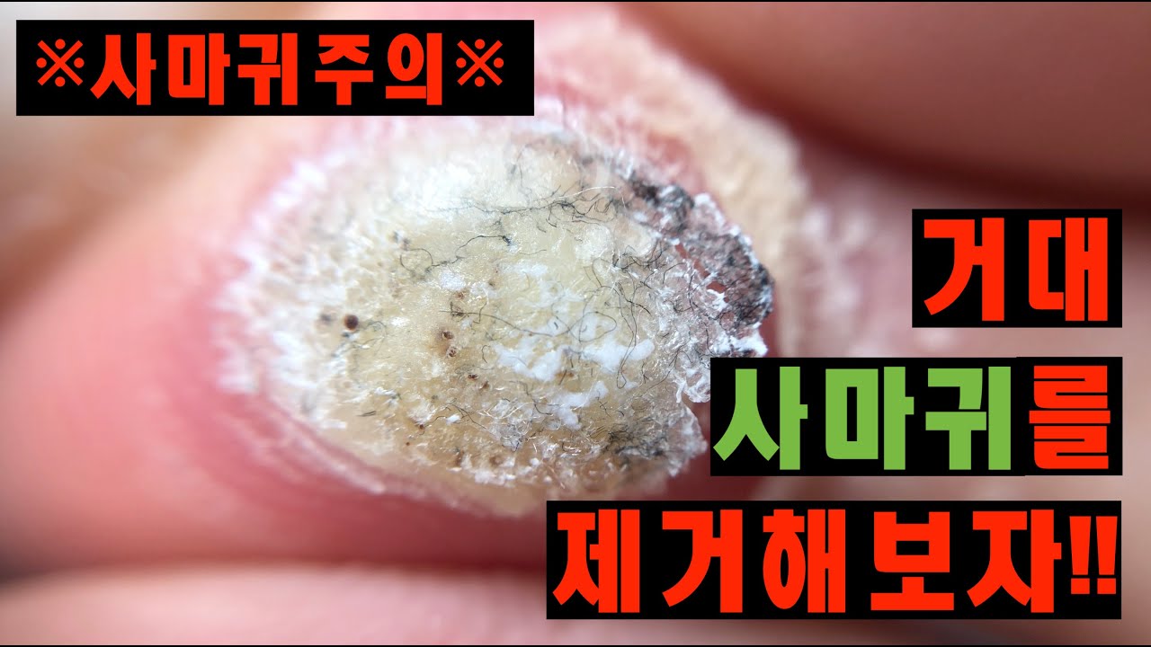 2년 묵은사마귀 셀프제거영상 Plantar Wart Treatment - Youtube