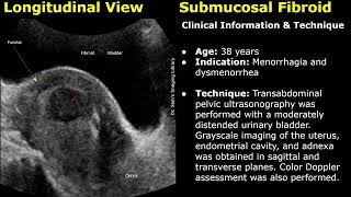 Fibroid Ultrasound Reporting | Submucosal, Calcified Fibroid and Enlarged Uterus Report Examples USG