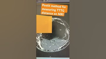 Method for determination of tibial tuberosity trochlea groove (TTTG) distance! #orthopedics #knee