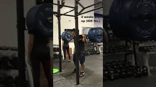 TRAINING COMEBACK (Appendix surgery) First squat in 3 weeks! (405 lb. squat, no belt)