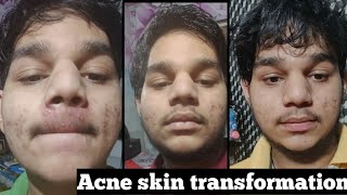 ?glow with shubham client acne skin transformation | acne skin transformation before & after results