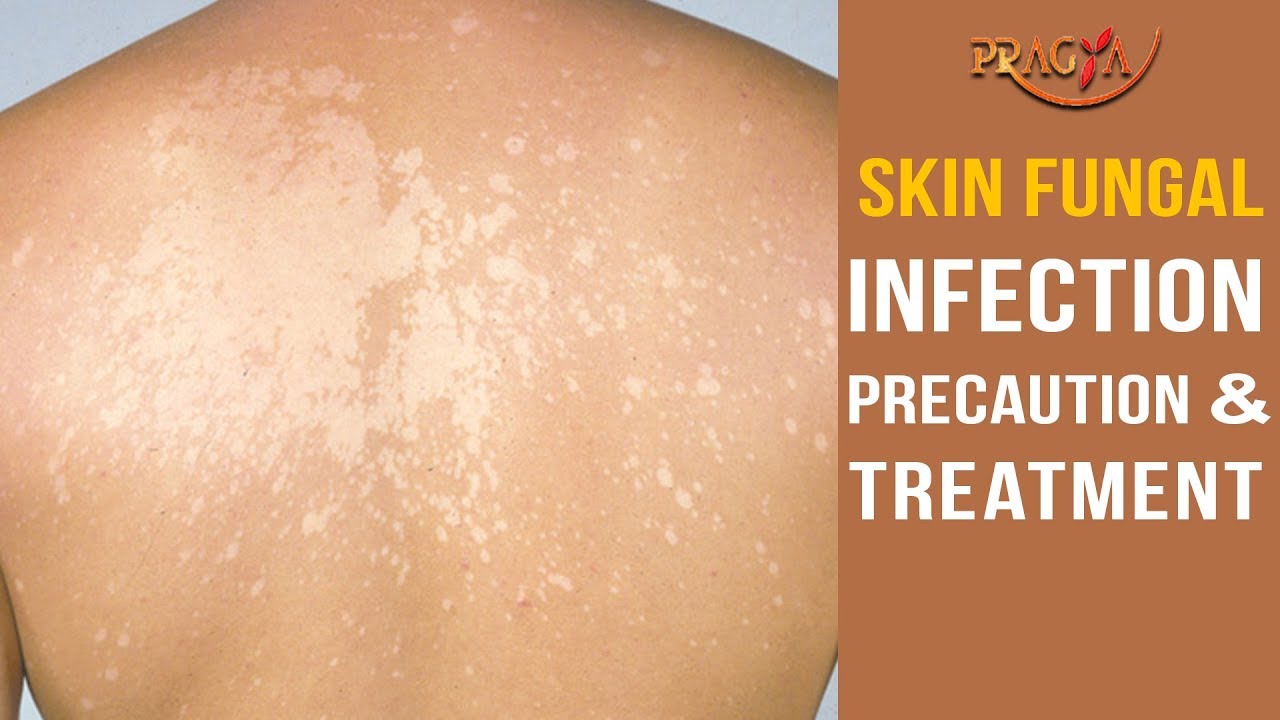 Watch Skin Fungal Infection Precaution And Treatment Youtube