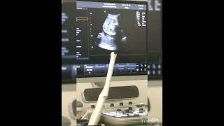 Ultrasonografi Pertama Kali Chrystin