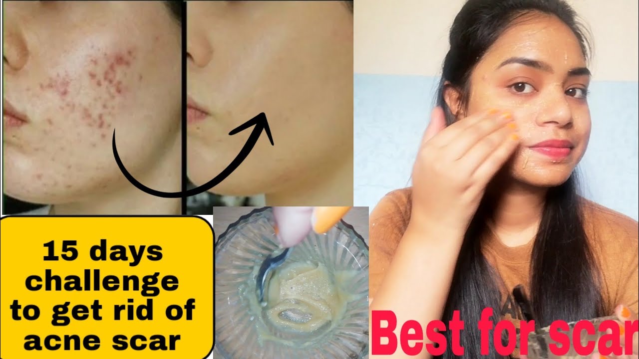 How to Remove Acne Scar, Dark Spots Fast 15 Days Challenge YouTube