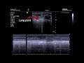 Lung Point, Seashore, Barcode sign (POCUS confirmed Pneumothorax)