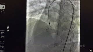 DRRAVIRT   PM VSD DEVICE CLOSURE USING KONAR MFO DEVICE