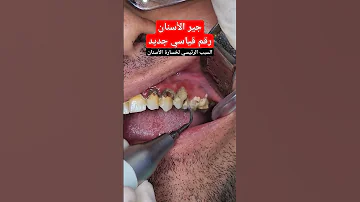 تنظيف جير الاسنان 