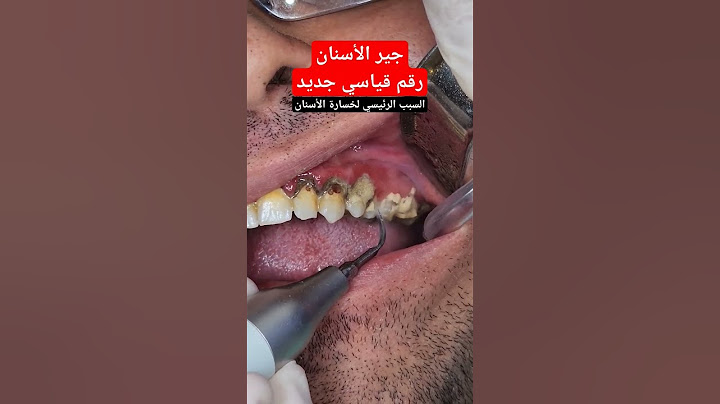 تنظيف جير الاسنان