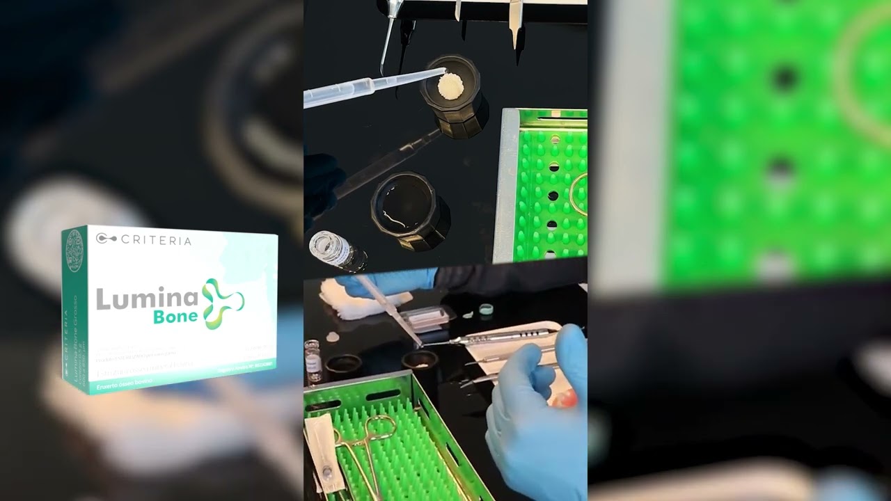 MANIPULAÇÃO COM LUMINA BONE, POR DR. GUSTAVO MOMESSO