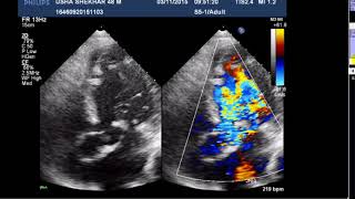 Infective Endocarditis Of Aortic Valve With Aortic Regurgitation Ar