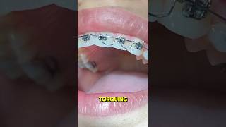 Torque Springs - A.R.T - Toothtime Family Dentistry New Braunfels