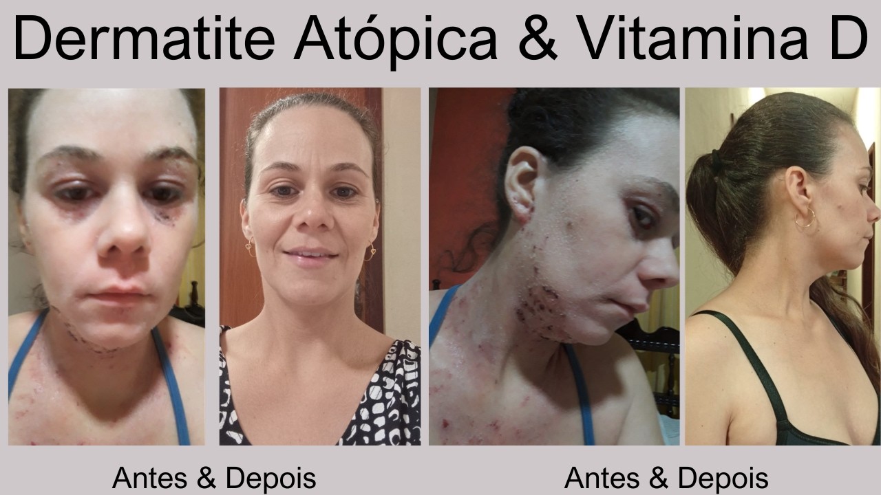 Karen - Dermatite Atópica #1116