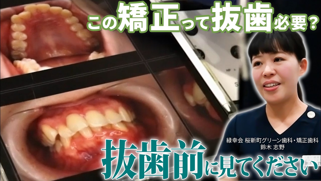 成人矯正 非抜歯 クリアコレクト マウスピース矯正 | 世田谷区桜新町