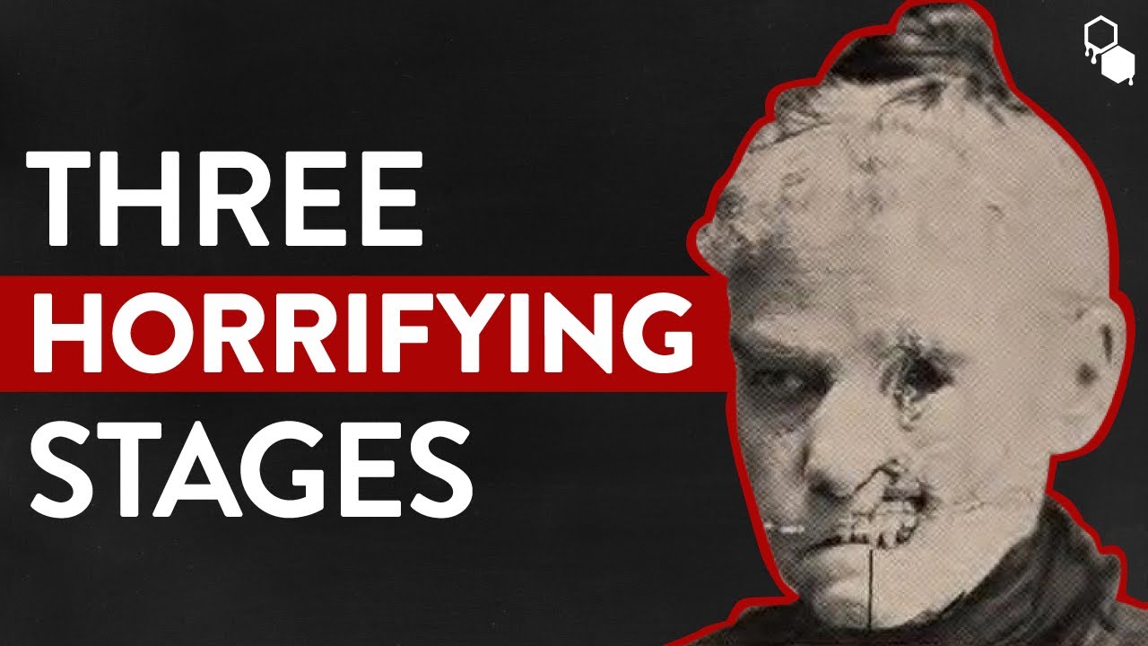 The Three Horrifying Stages Of Syphilis YouTube