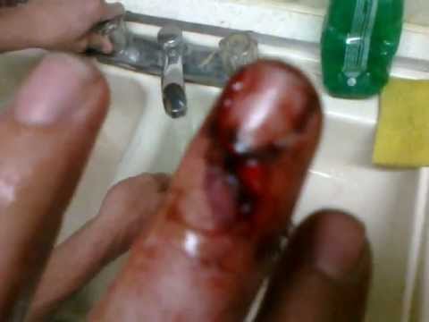 como limpar e enfaixar um dedo quebrado