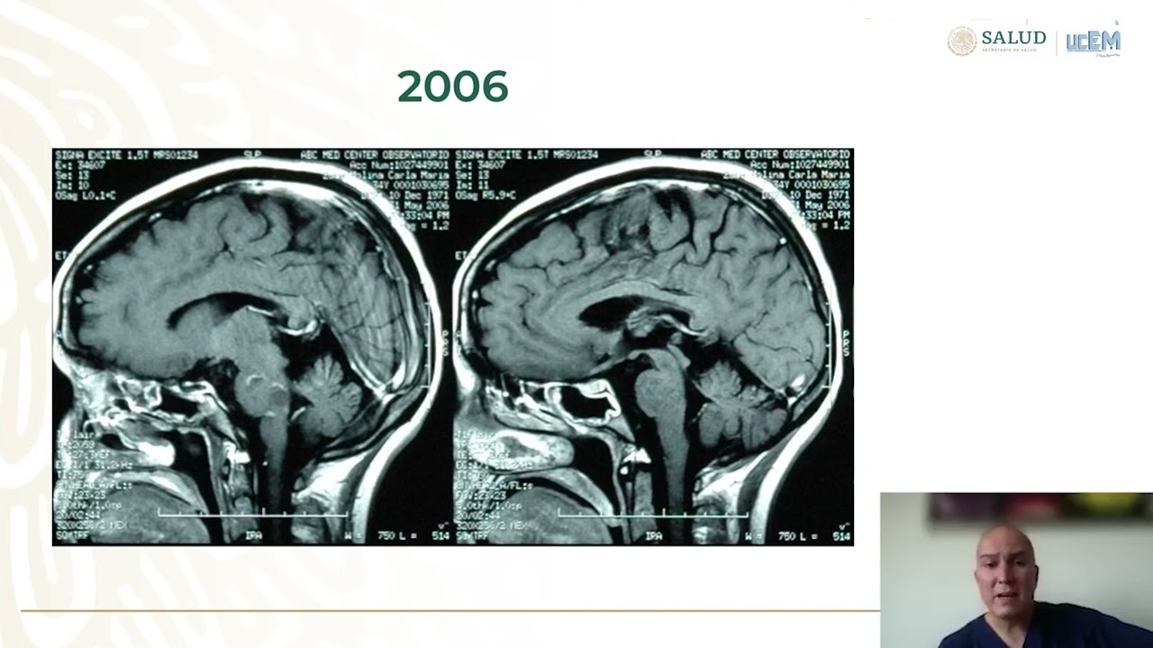 Diagnóstico diferencial en esclerosis múltiple