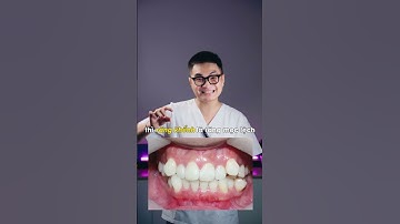 Niềng răng giữ lại răng khểnh được không | Nha Khoa Vidental #shorts #fyp #xuhuong #trending #rap