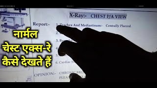 Chest X ray Report Read In Hindi l How To Read Chest X-ray Report | एक्स रे  रिपोर्ट कैसे देखें screenshot 5