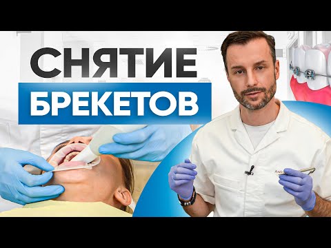 Снятие брекетов на реальном примере! Что делать после того как сняли брекеты?