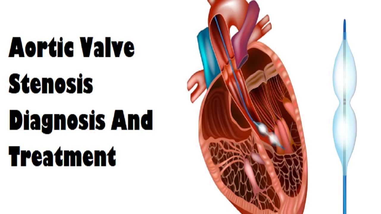 Aortic Valve Stenosis Diagnosis And Treatment