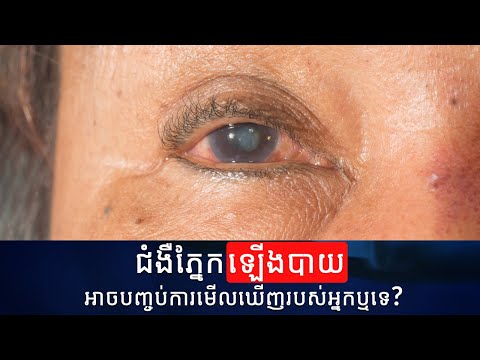 ជំងឺភ្នែកឡើងបាយ អាចបញ្ចប់ការមើលឃើញរបស់អ្នកឬទេ | Senile Cataract Can End Your Vision