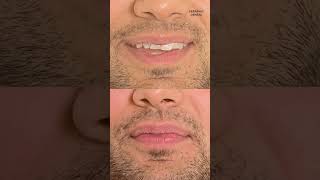 Dental Veneers Procedure Smile Makeover In Indore