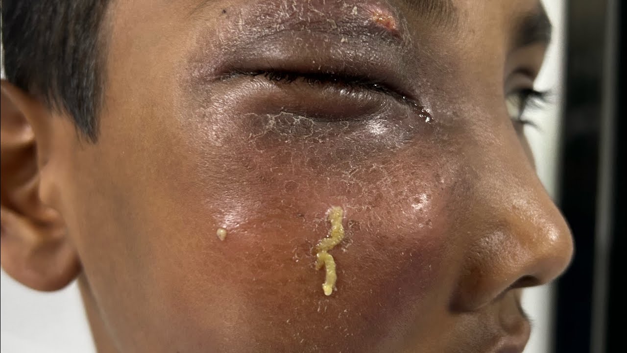 Reading a Sinonasal Ossifying Fibroma Scan. 