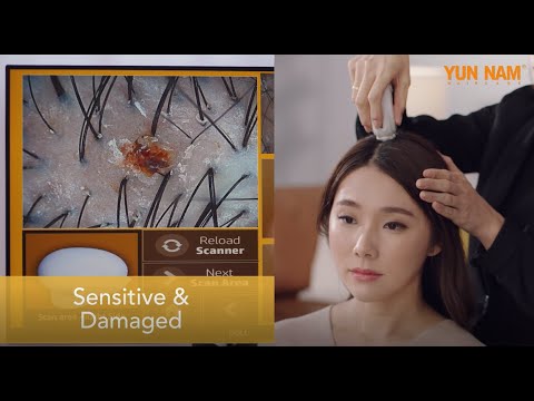 Real life Experiences with Hair Loss | Yun Nam Hair Care