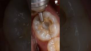 Deep Cavity Removal Satisfying 😬 Molar Restoration Before → After #ai #shorts #satisfying #tranding