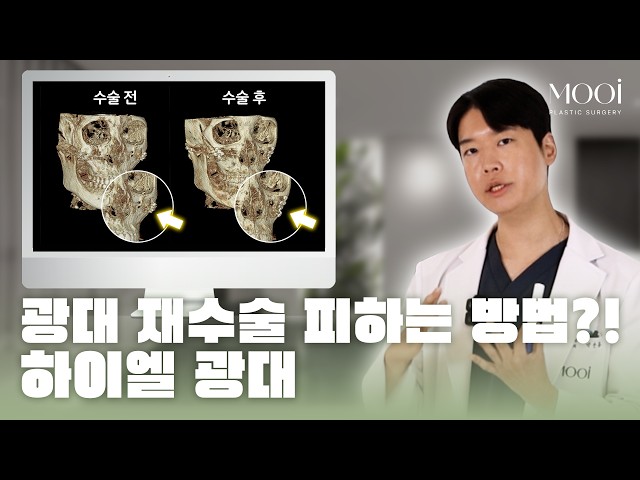 광대 재수술, 왜 효과가 없었을까?|45도 광대 개선의 핵심은 'ㅇㅇㅇ' #광대재수술 #옆광대 #윤곽수술