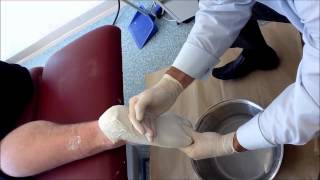 Stewart Hayes, Sports Podiatrist - Negative Casting Technique