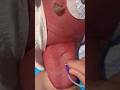 Baby ka Arterial Blood nahi nikal raha? Ye dekho 💉😱 #shorts #viral #youtubeshorts #baby