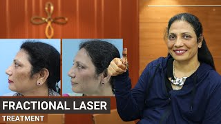 Fractional Laser | Fractional Laser Before and After | Fractional Laser Journey | C02 Fractional