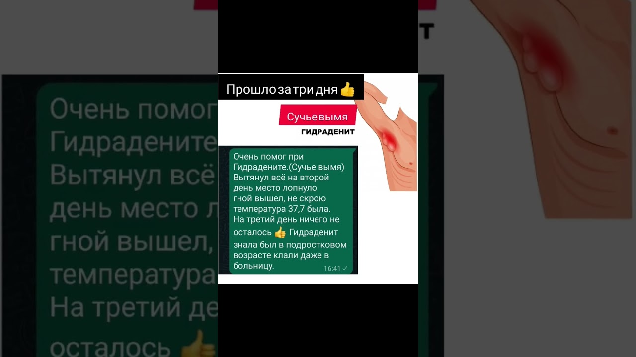 Сучье вымя или Гидраденит, что поможет?