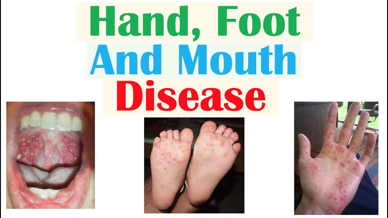 Hand, Foot and Mouth Disease | Viruses, Pathophysiology, Signs and Symptoms,  Diagnosis, Treatment - YouTube