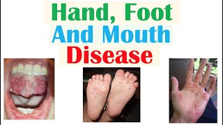 Hand, Foot and Mouth Disease | Viruses, Pathophysiology, Signs and Symptoms, Diagnosis, Treatment screenshot 2