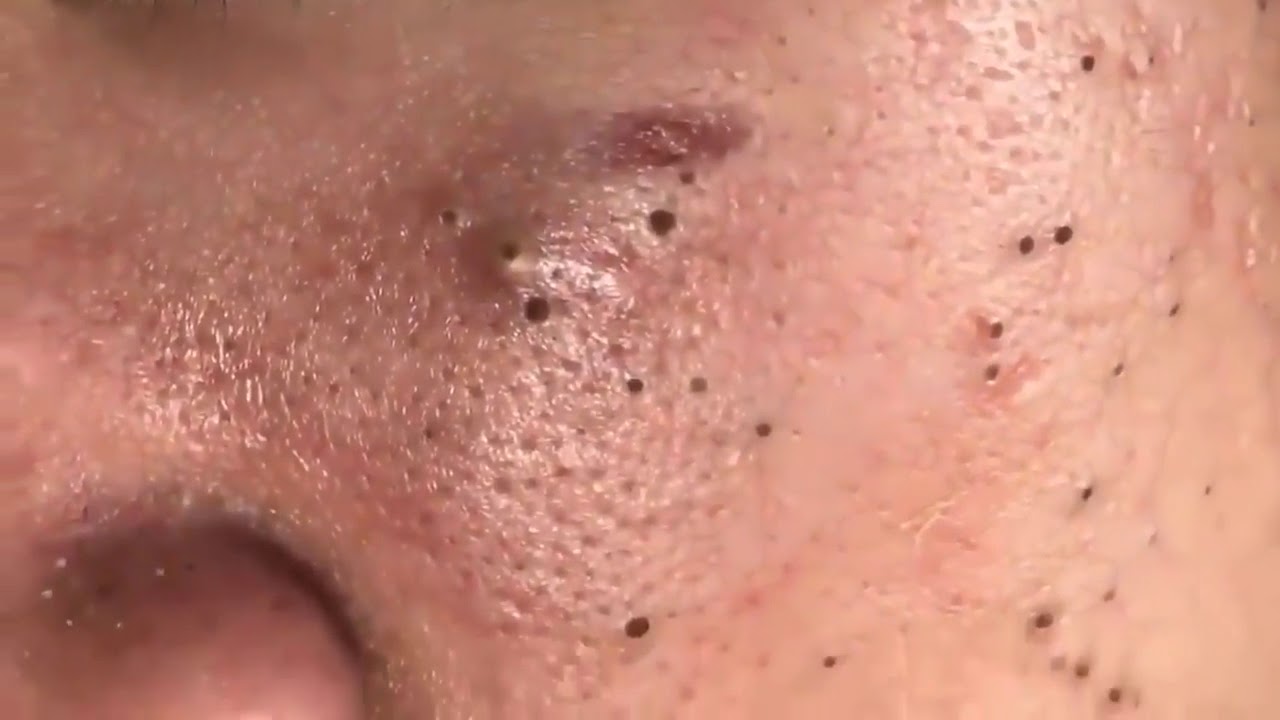 إزالة النقاط السوداء BLACKHEAD REMOVAl YouTube