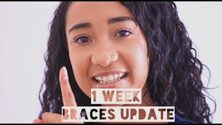 1 Week Braces Update | Clear Ceramic Adult Braces | South African Youtuber