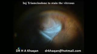Basic Vitrectomy for RRD , C,  By Prof Dr Hussain Ahmad Khaqan
