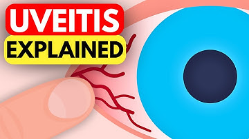 Wat is uveïtis? Oorzaken, symptomen en diagnose uitgelegd met animaties.