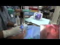 GlideScope Pediatric Airway Rounds Case Study: 7 year old, Apert Syndrome