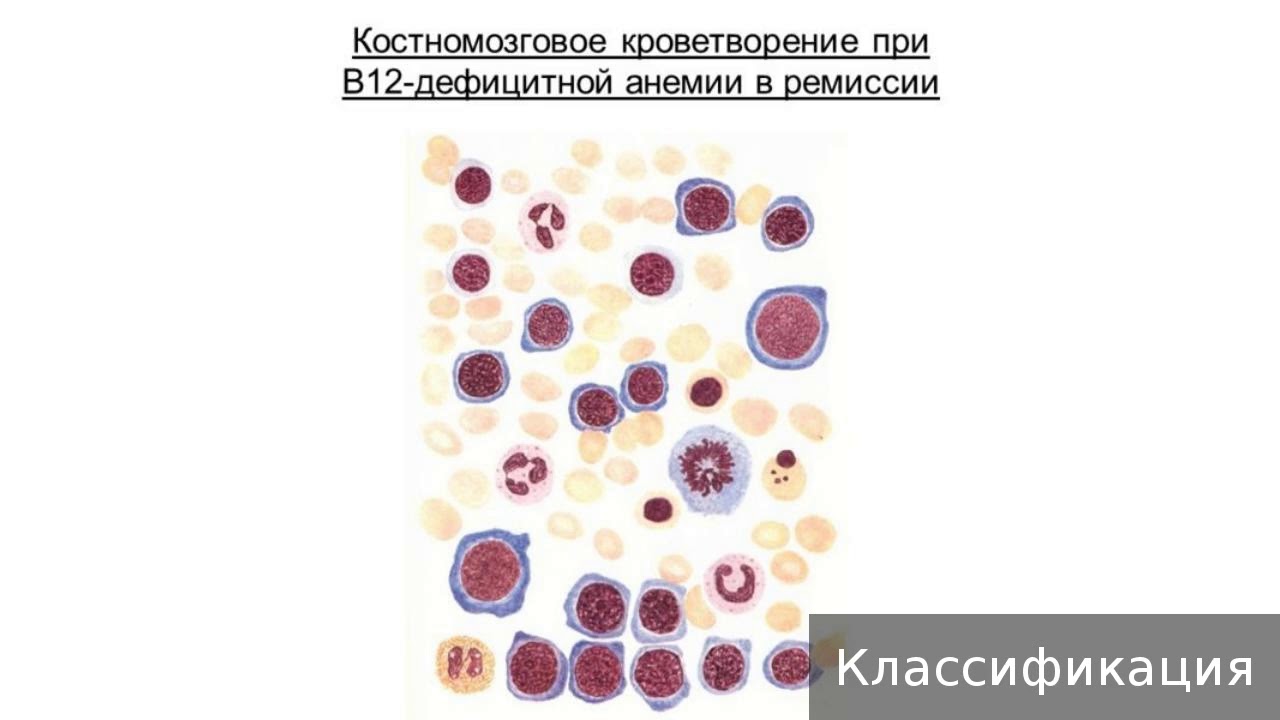 В12 при железодефицитной анемии. В12 фолиеводефицитная анемия картина крови. Б12 дефицитная анемия кровь. Картина крови при в12 дефицитной анемии. B12 дефицитная анемия ОАК.