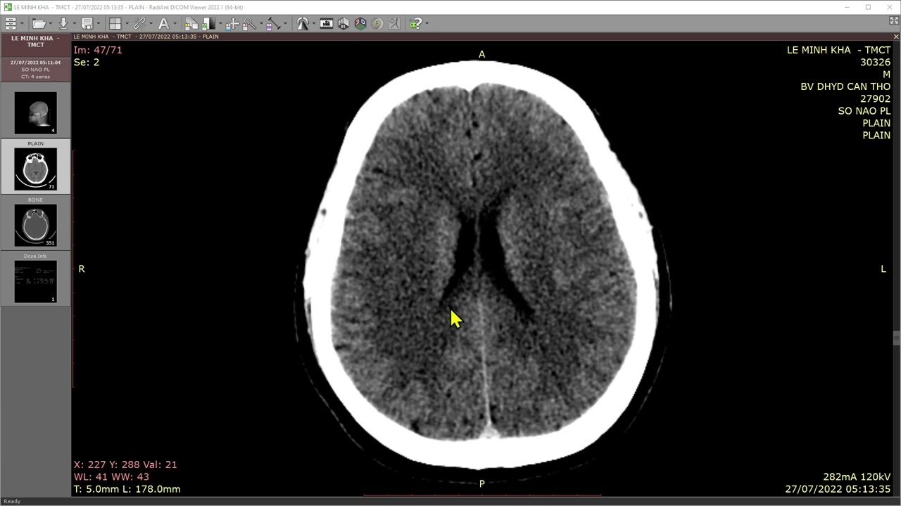 Buoi 46- Giai phau CT-MRI nao