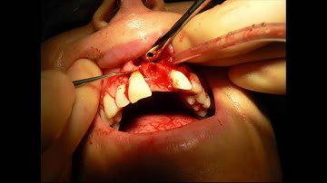 Webinar Ridge preservation and extraction socket management 30 09 15