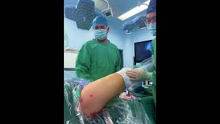 Gluteal muscle contracture release, arthroscopic minimally invasive