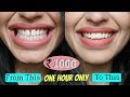 How I Fixed My Teeth In (Just ₹1000) in One Hour Without Braces | Diwalog Day 4