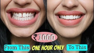 How I Fixed My Teeth In (Just ₹1000) in One Hour Without Braces | Diwalog Day 4