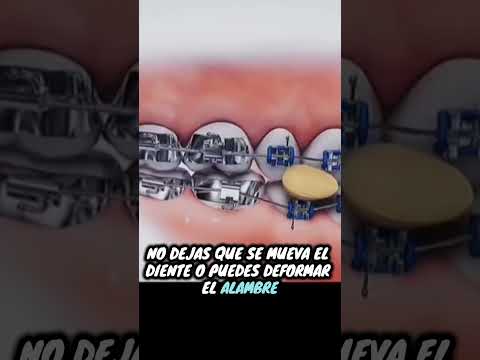 Arruinas tu tratamiento de brackets sin saberlo