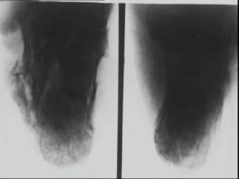 Reduction and treatment of a fracture of the calcaneus (1933), pt 1 of 2