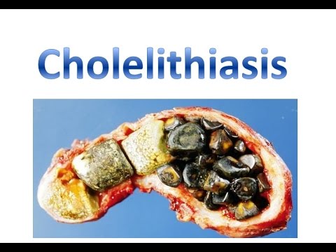 Cholelithiasis